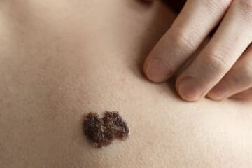 Free Skin Cancer Check at the Show