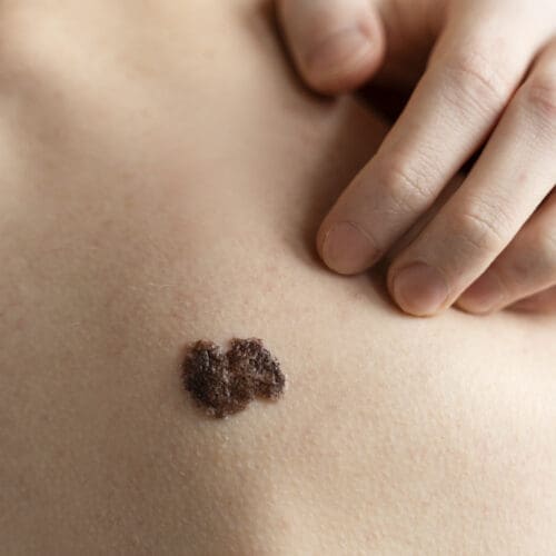 Free Skin Cancer Check at the Show