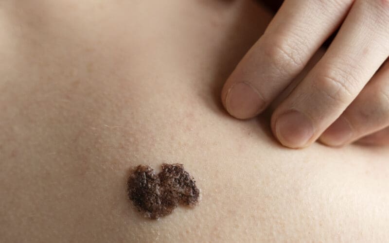 close up hand scratching skin near mole